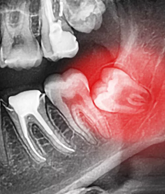 wisdom teeth xray